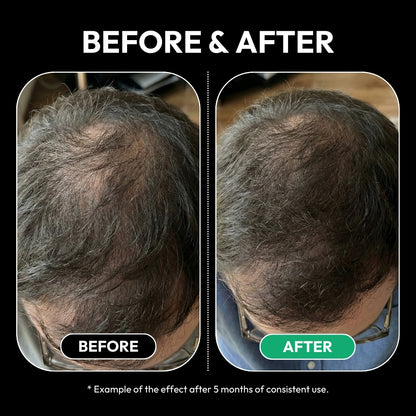 Before and after example of visibly thicker hair on a man's crown after 5 months of consistent ZENLUCA use
