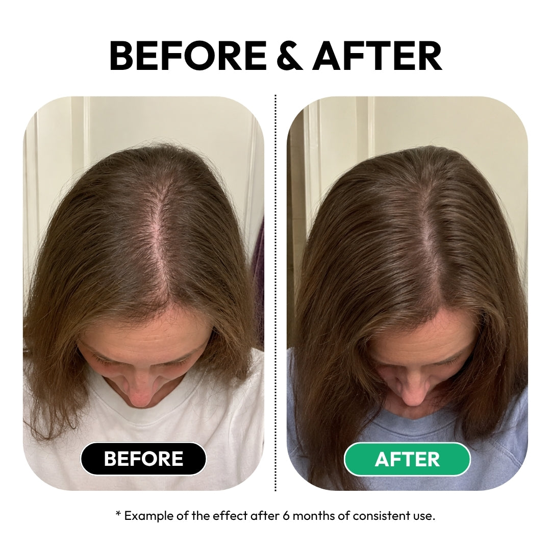 Before and after example of visibly thicker hair and reduced scalp show-through after 6 months of consistent ZENLUCA use